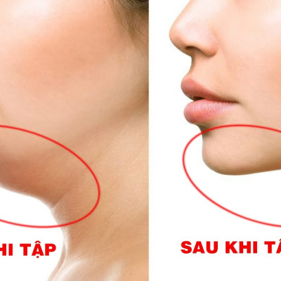 Máy xóa nọng cằm nâng cơ mặt định hình Vline Sothing H1031- Hàng chính hãng